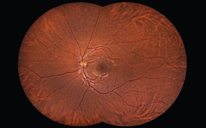 Wide-field image of a retina